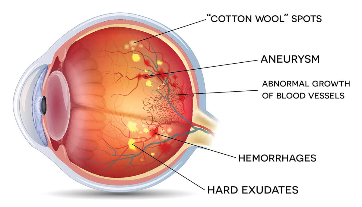 Διαβιτική αμφιβληστροειδοπάθεια