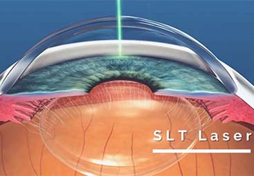 SLT laser για θεραπεία γλαυκώματος