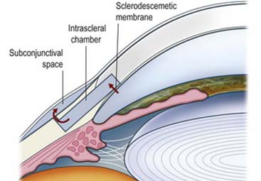 Εν τω βάθει σκληρεκτομή