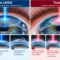 Διαθλαστική Χειρουργική: LASIK ή TransPRK;